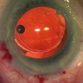 Chrirurgie de la cataracte (implant cristallinien)