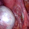 endométriose