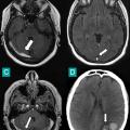 thrombose