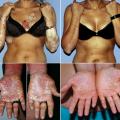 psoriasis