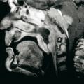 Carcinome indifférencié de type nasopharyngé
