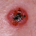 carcinome