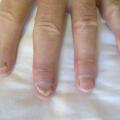 psoriasis
