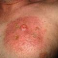 Lymphome T cutané