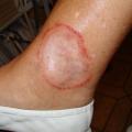 Dermatophytie modifiée par des corticoïdes