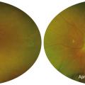 retinopathie diabetique