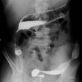 Adénocarcinome colique 