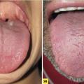 psoriasis de la langue