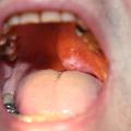 Adénocarcinome