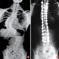 Traitement chirurgical d’une scoliose