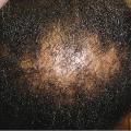 alopecie