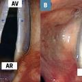 larynx