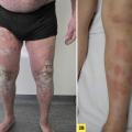 Psoriasis