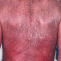 Lymphome T cutané : syndrome de Sézary