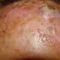 Carcinome épidermoïde invasif sur kératose actinique