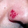 herpes narinaire - © Saskia Ingen-Housz-Oro (La Revue du Praticien)