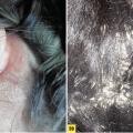 psoriasis
