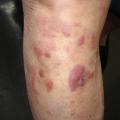 Lymphome T cutané