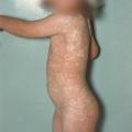 erythème infectieux