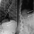 fracture vertébrale