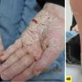 psoriasis