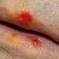 Chancre d'une syphilis primaire 