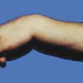 FRACTURES DU RADIUS