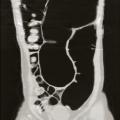 Volvulus du sigmoïde