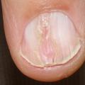 Ongle