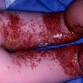 Herpes