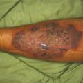 pyoderma