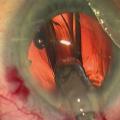 EXTRACTION DE CATARACTE