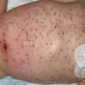 Varicelle surinfectée