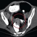 occlusion intestinale