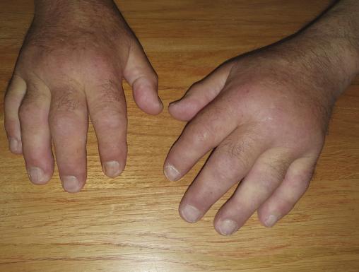 Œdème des mains (Syndrome RS3PE paranéoplasique)