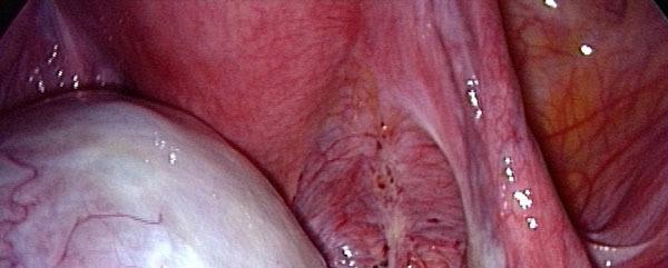 endométriose