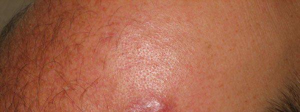Quest Ce Que Le Lymphome Cutan Fle